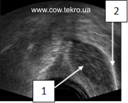 Exograma yayechnyka za gipotrofiyi